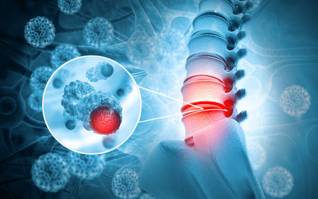 ¿Un tumor óseo siempre significa cáncer? Experta de Mayo Clinic lo explica Los tipos más frecuentes de cáncer óseo varían según la edad