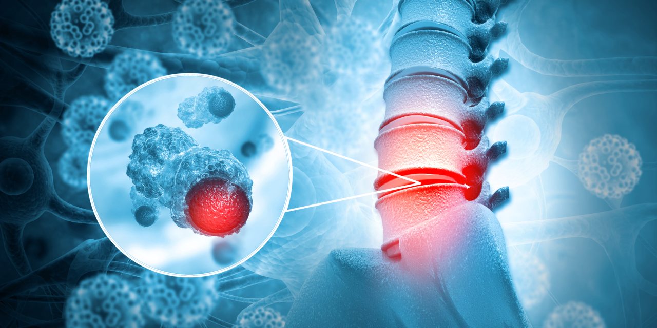 ¿Un tumor óseo siempre significa cáncer? Experta de Mayo Clinic lo explica Los tipos más frecuentes de cáncer óseo varían según la edad