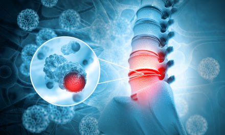 ¿Un tumor óseo siempre significa cáncer? Experta de Mayo Clinic lo explica Los tipos más frecuentes de cáncer óseo varían según la edad