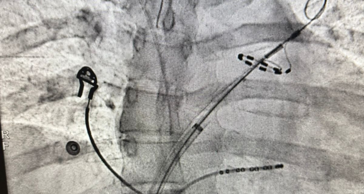 FIBRILACIÓN AURICULAR: TRATAR ANTES PARAPROTEGER EL CORAZÓN Y REDUCIR COMPLICACIONES