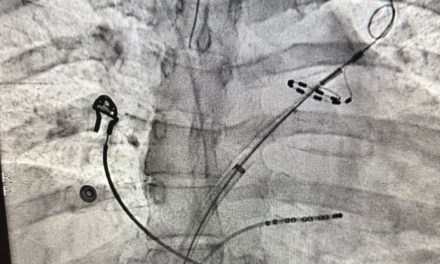 FIBRILACIÓN AURICULAR: TRATAR ANTES PARAPROTEGER EL CORAZÓN Y REDUCIR COMPLICACIONES